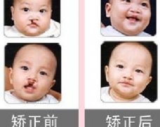 吃兔肉真的會(huì)長兔唇？為什么會(huì)長兔唇？